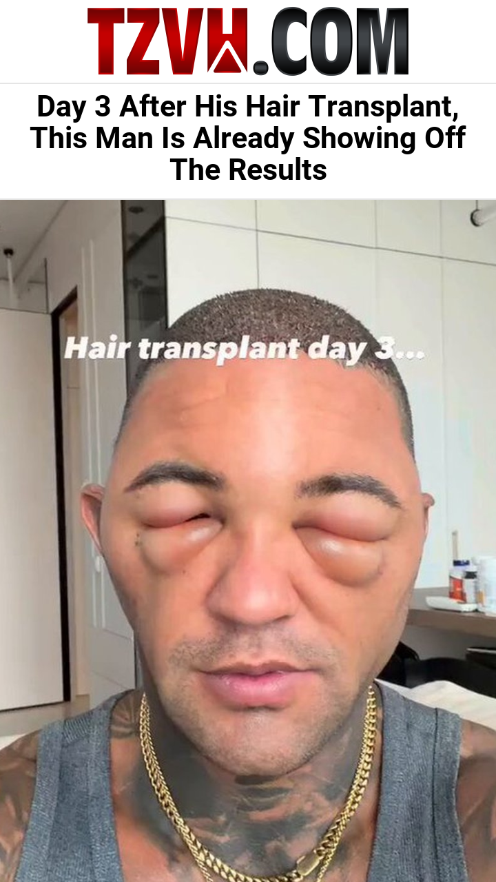 Day 3 After His Hair Transplant, This Man Is Already Showing Off The Results