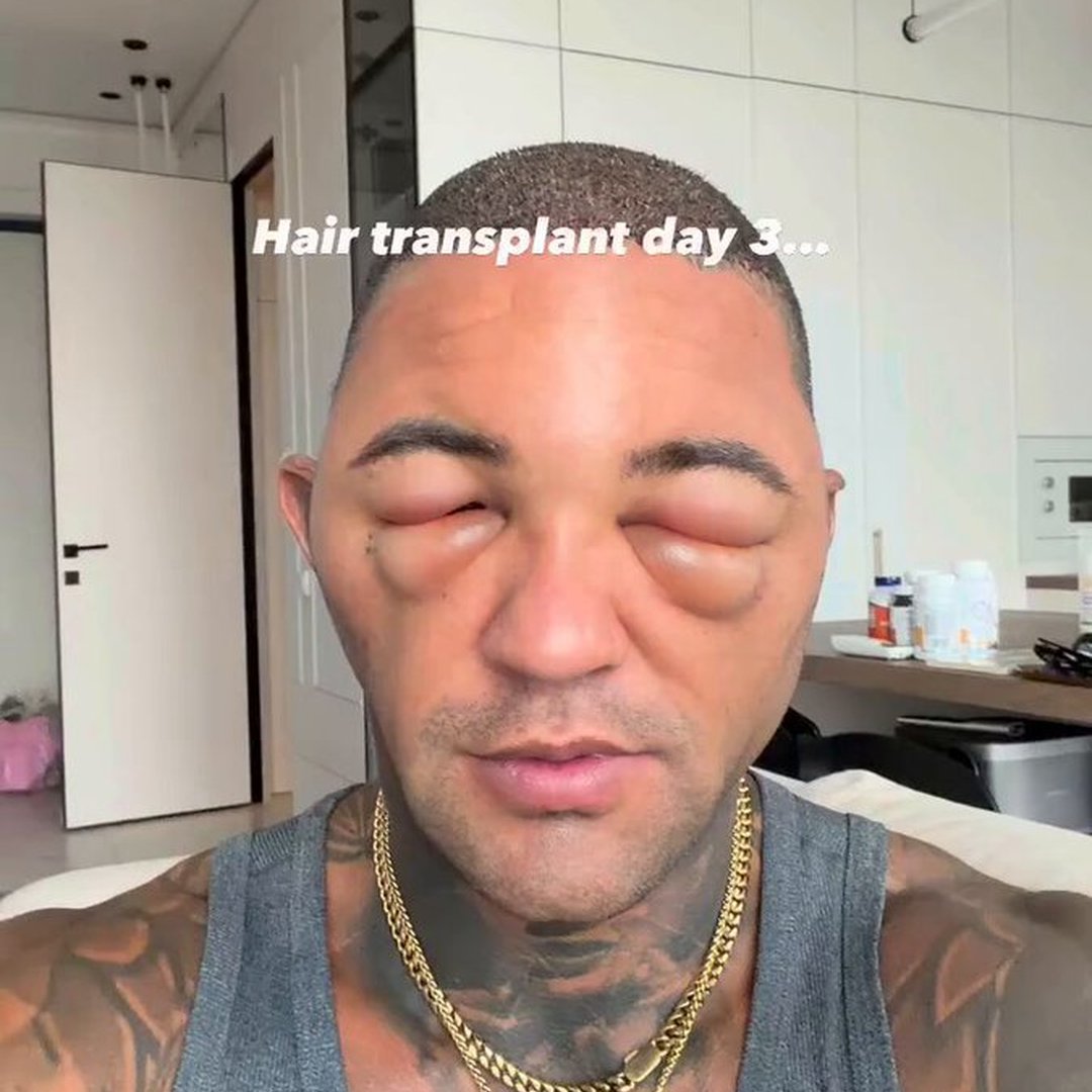 Day 3 After His Hair Transplant, This Man Is Already Showing Off The Results