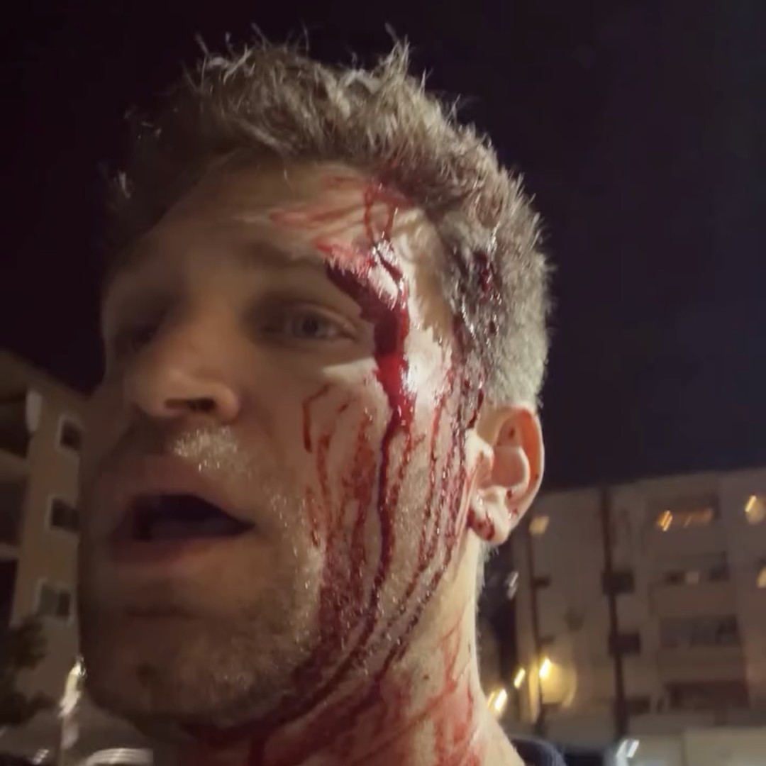 “Pretty Little Liars” Actor Keegan Allen Pistol-Whipped and Robbed in Southern California