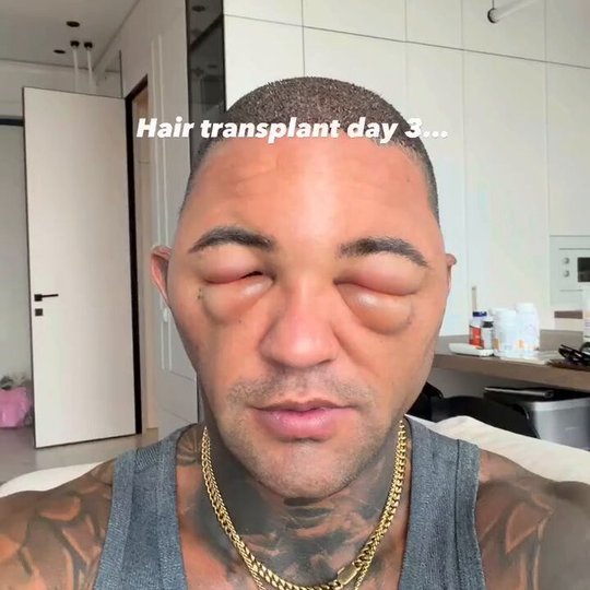 Day 3 After His Hair Transplant, This Man Is Already Showing Off The Results